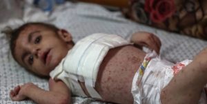 5d8828b989779ac421af1f27fa9a292c 1.8 مليون حالة مرضية في غزة بسبب النزوح وانعدام الخدمة الصحية