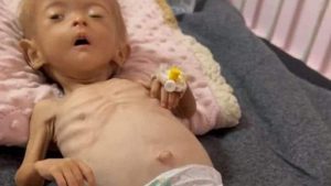 استشهاد طفلة في غزة جراء المجاعة