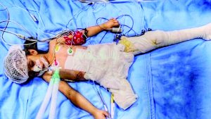 طفلة فلسطينية مقطعت الاطراف الأورومتوسطي: المنظومة الدولية أظهرت فشلًا مشينًا في وقف الإبادة بغزة