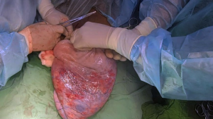 مستشفى همدان العام 1 إجراء عملية نوعية في مستشفى همدان العام بصنعاء