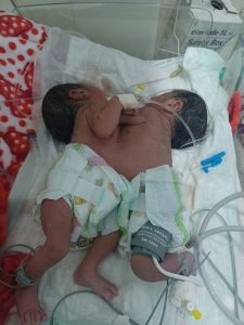 IMG_20250318_002011_922 وفاة توأم سيامي ملاصق في صنعاء