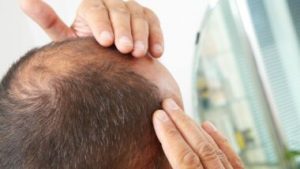 علماء يتوصلون إلى بروتين لعلاج تساقط الشعر