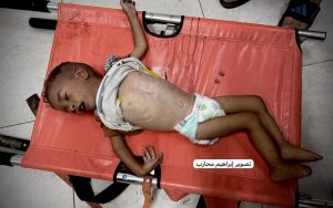 3 وفيات جديدة ترفع حصيلة سوء التغذية والمجاعة بغزة إلى 154 حالة