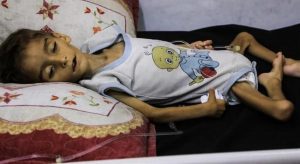 استشهاد شقيقين استشهاد شقيقين فلسطينيين بسوء التغذية في مدينة غزة