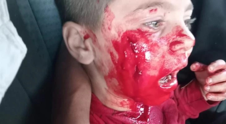 إصابة طفل فلسطيني باعتداء مستوطنين صهاينة في الخليل