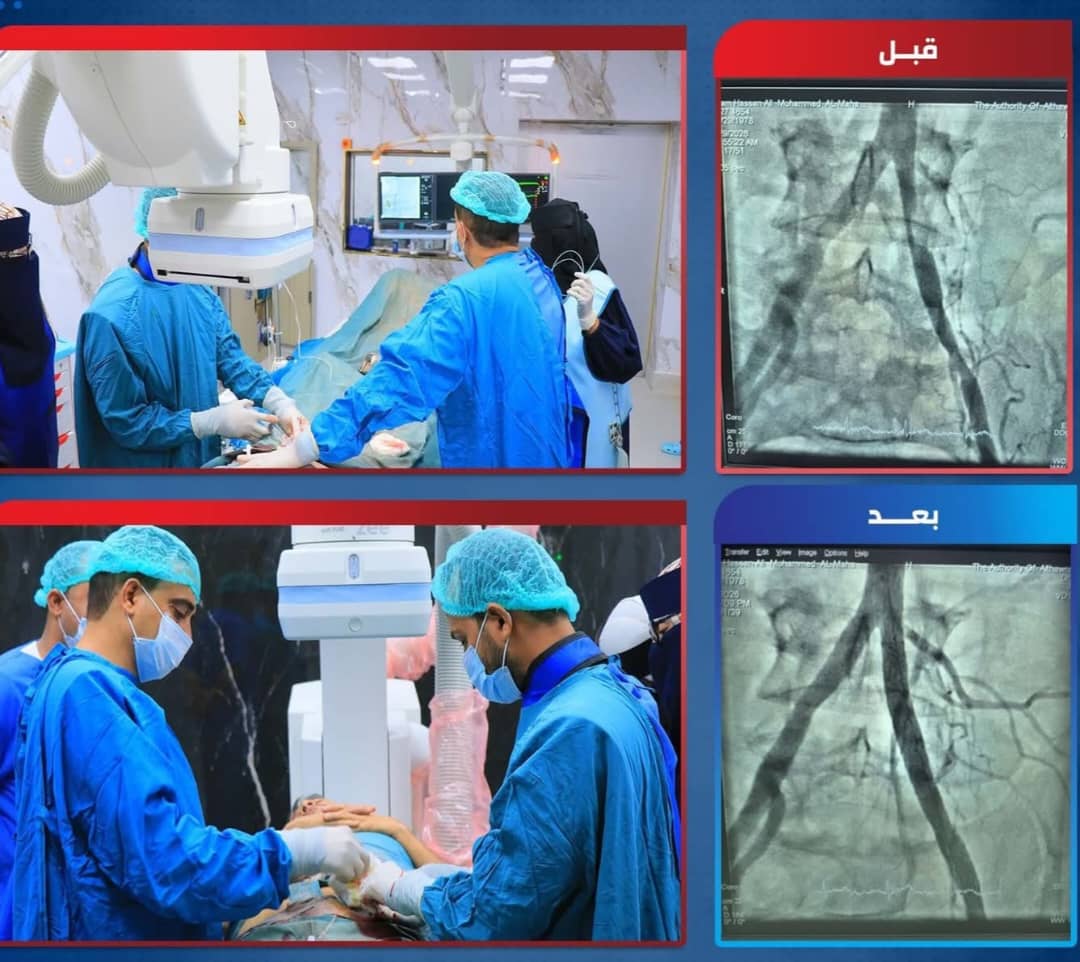 نجاح أول عملية قسطرة طرفية في مستشفى الثورة بالحديدة