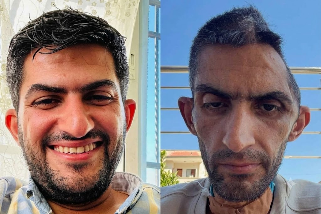 صورة صادمة تكشف فضاعة ما تعرض له أسير فلسطيني داخل سجون الاحتلال